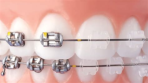 brackets metalicos esteticos o de porcelana|Brackets: Tipos y Diferencias entre metálicos y .